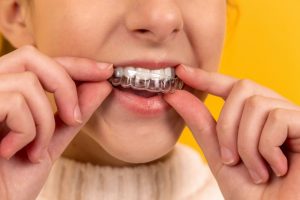 Myths About Invisalign for Teeth Misalignment
